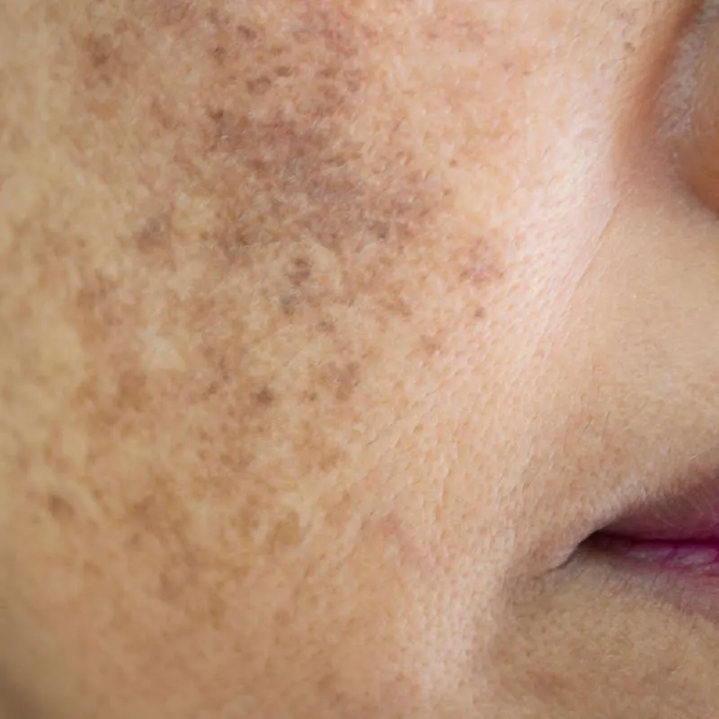 Sun Damage, Brown Spots & Hyperpigmentation